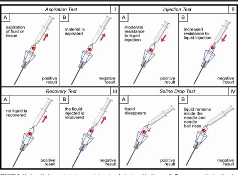 the needle drop testing|An evaluation of four tests used to ascertain Veres needle.